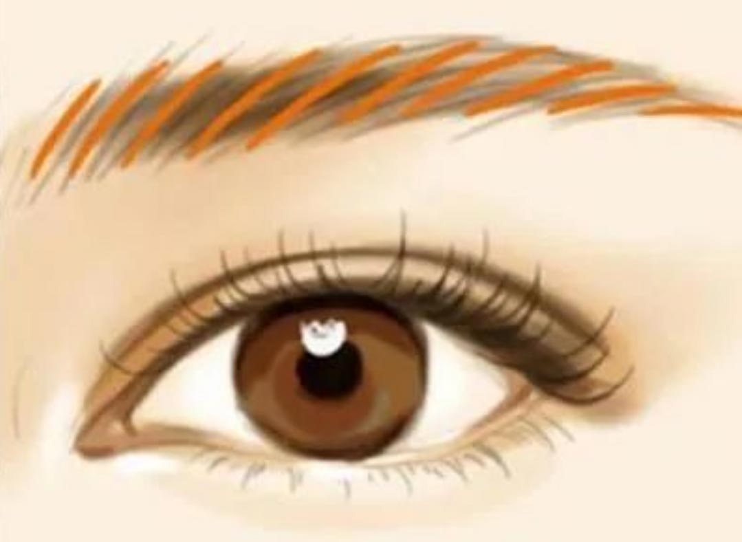 Zal het verwijderen van lasermicroblading (verwijdering van wenkbrauwtatoeages) littekens achterlaten?